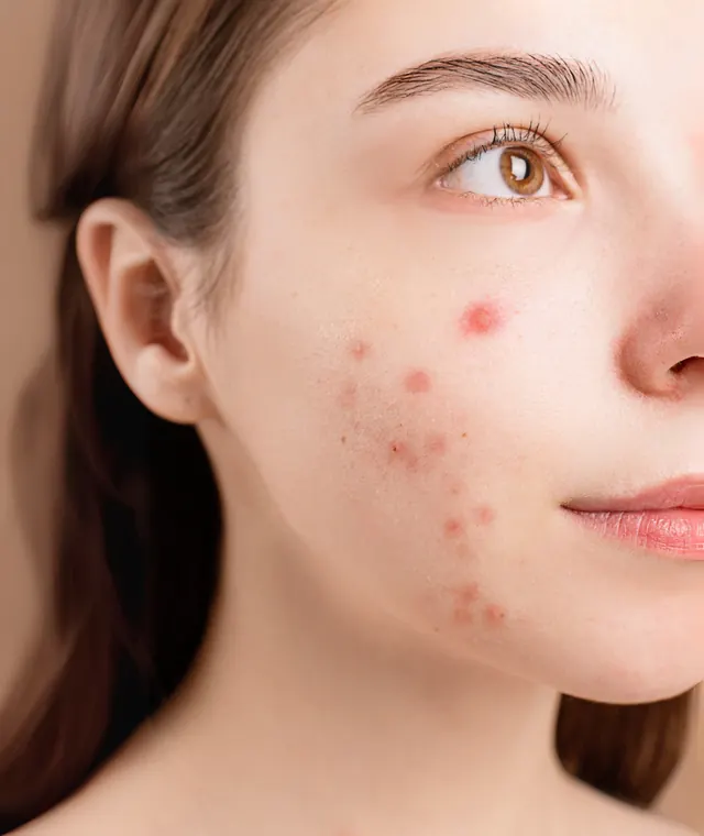 Jovem de perfil com marcas de acne na bochecha