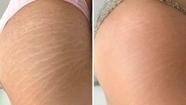 Pele das coxas com textura irregular de celulite