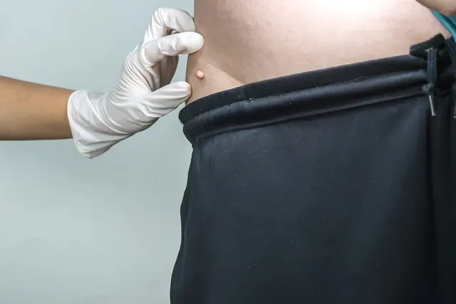 Profissional de luvas avaliando pequenas lesões de pele no corpo
